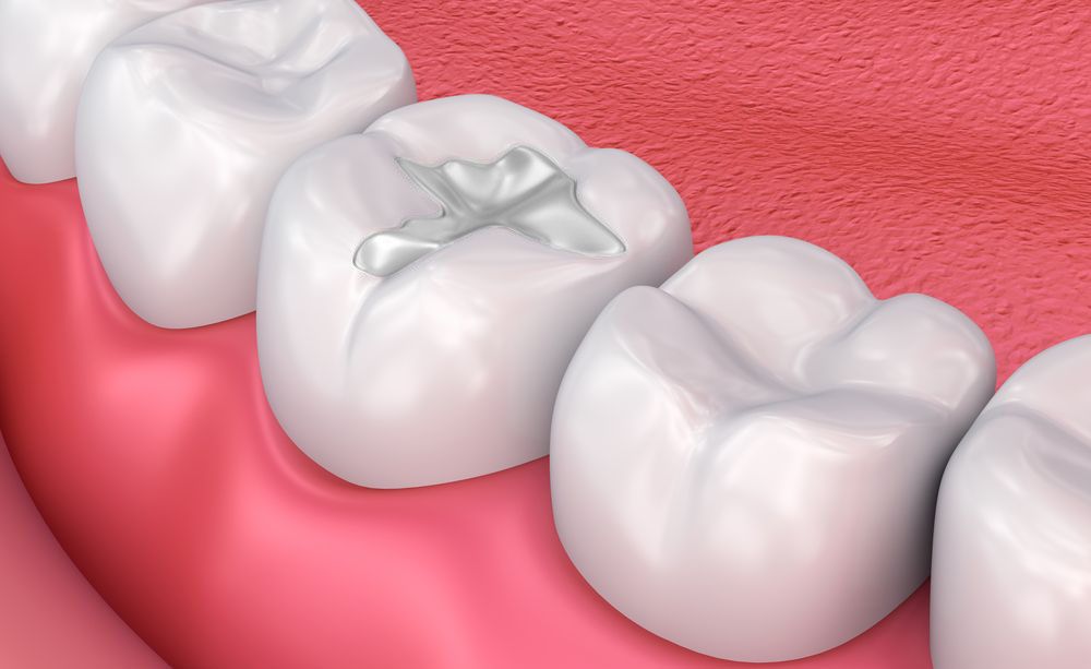 Illustration of a white dental filling.